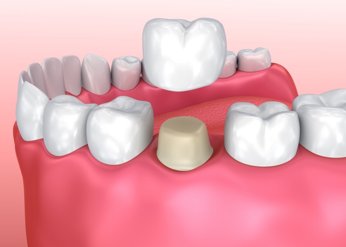 diagram of a dental crown