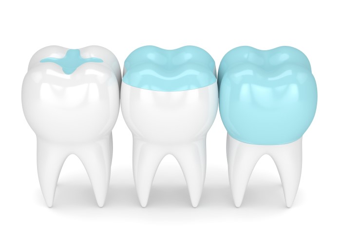 diagram of dental inlay, onlay, and crown