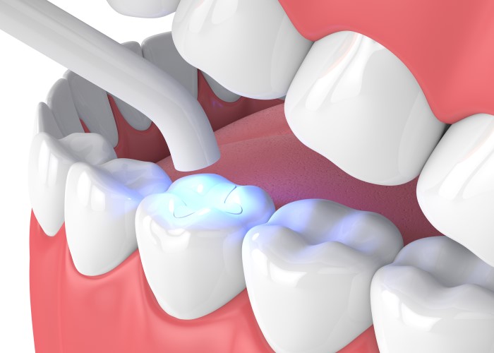 diagram of dental inlay being cured